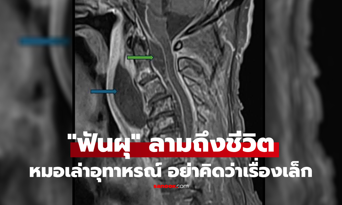 В Таиланде мужчину убило запущенное воспаление зуба: инфекция распространилась на позвоночник