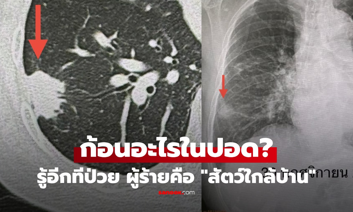 В Таиланде женщина, не курившая и без симптомов, столкнулась с серьезным заболеванием легких